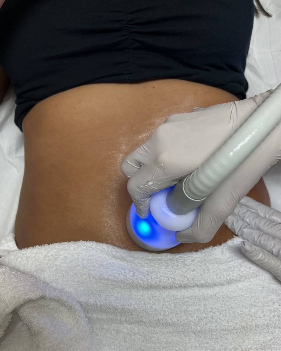 Cryoskin 101: How It Works and Who It Is For