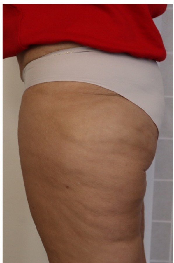 CryoSkin client after, thighs + cellulite
