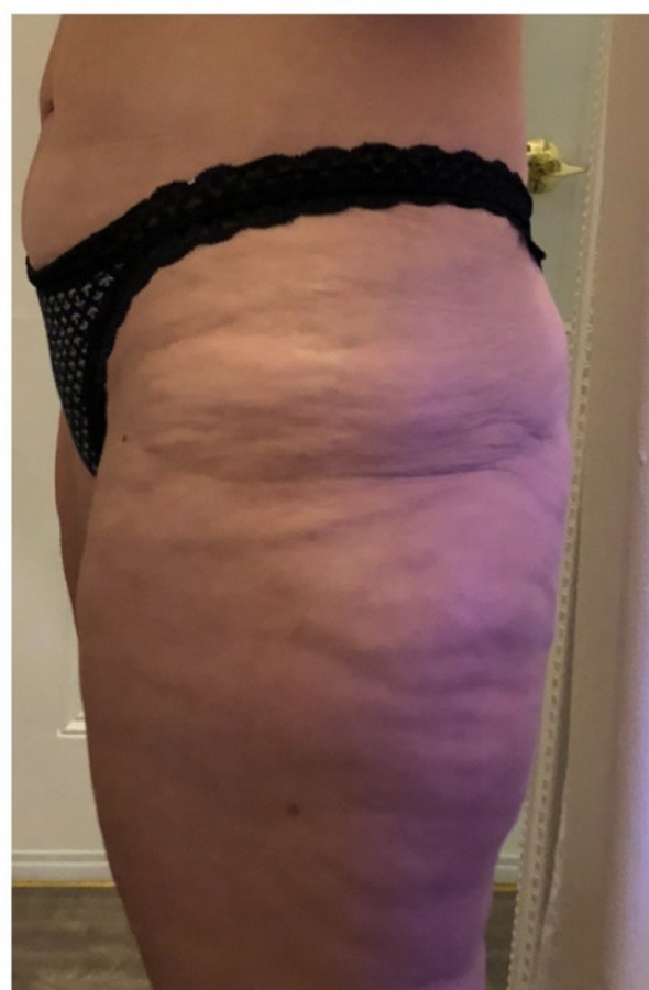 CryoSkin client before, thighs + cellulite