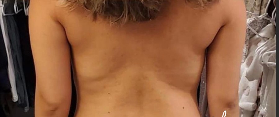 CryoSkin client after, back