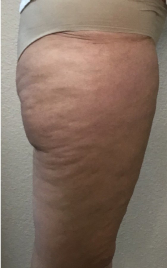 CryoSkin client after, thighs + cellulite