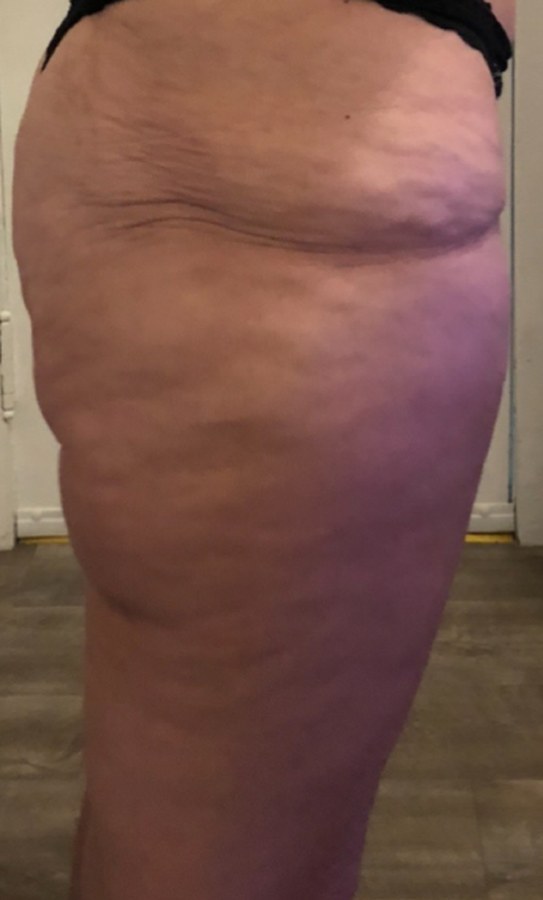 CryoSkin client before, thighs + cellulite