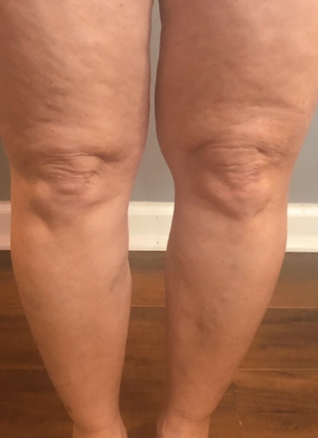 CryoSkin client after, knees + thighs