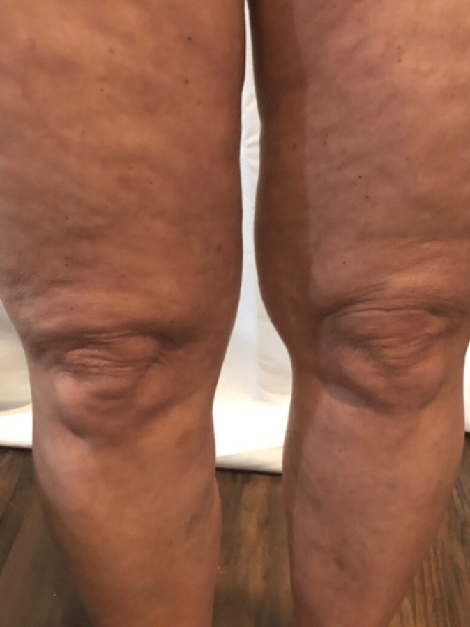 CryoSkin client before, knees + thighs