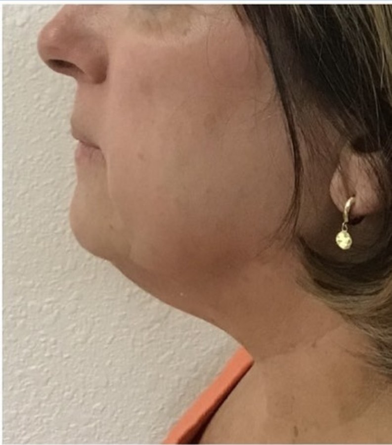 CryoSkin client after, chin + jawline