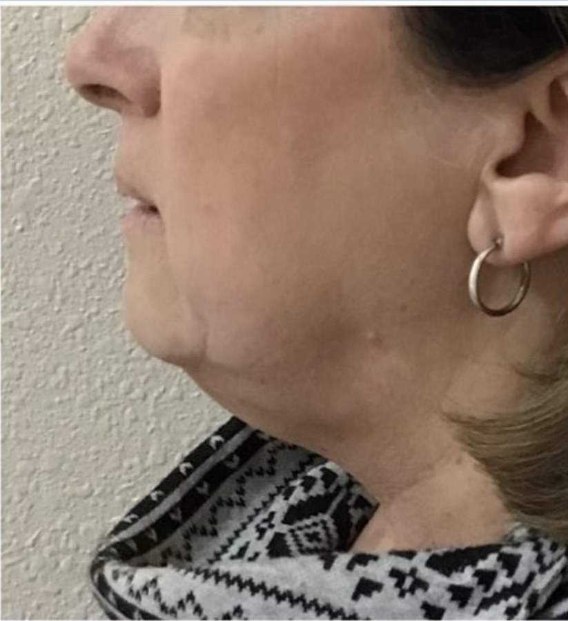 CryoSkin client before, chin + jawline