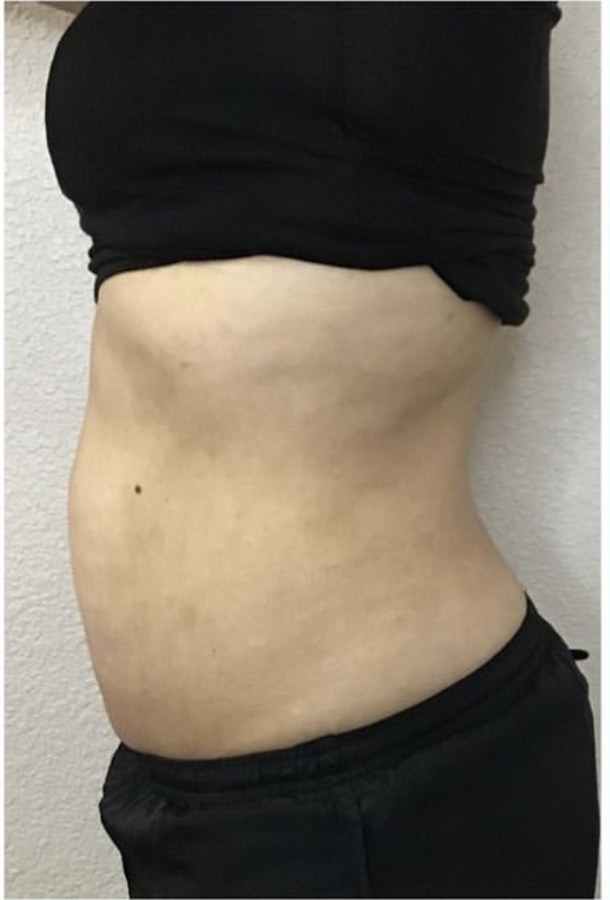 CryoSkin client after, stomach