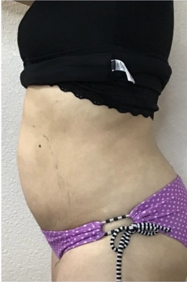 CryoSkin client before, stomach
