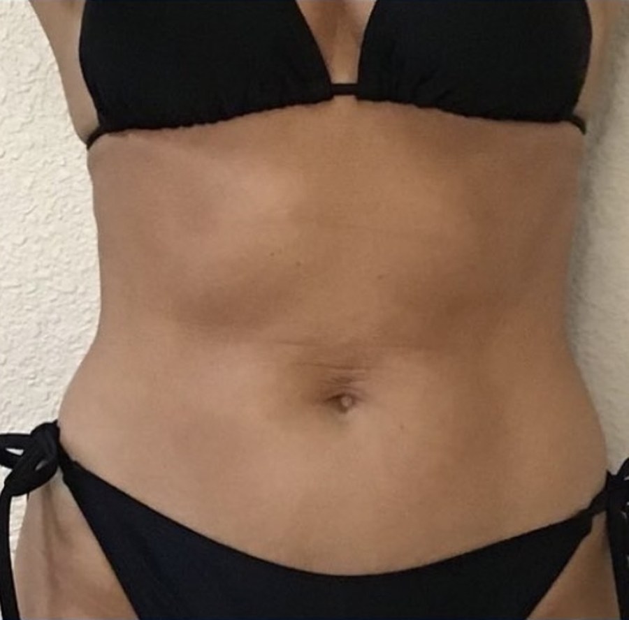 CryoSkin client after, stomach