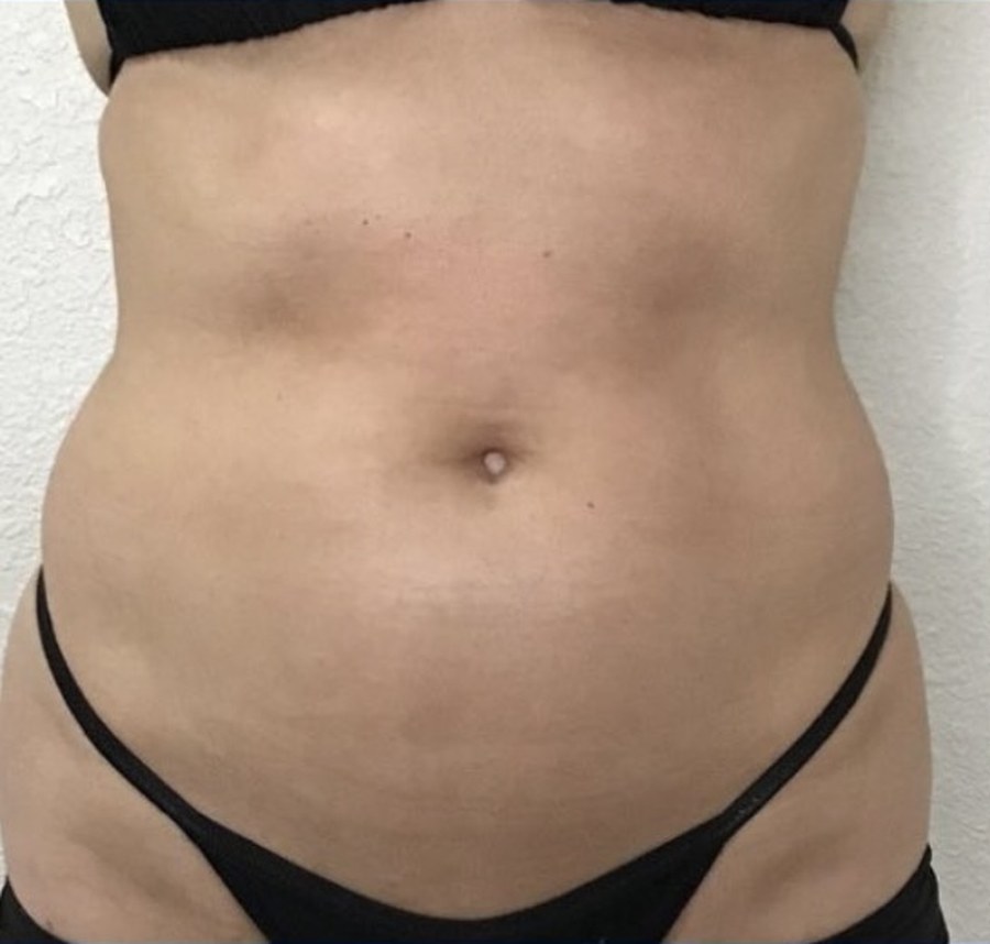 CryoSkin client before, stomach