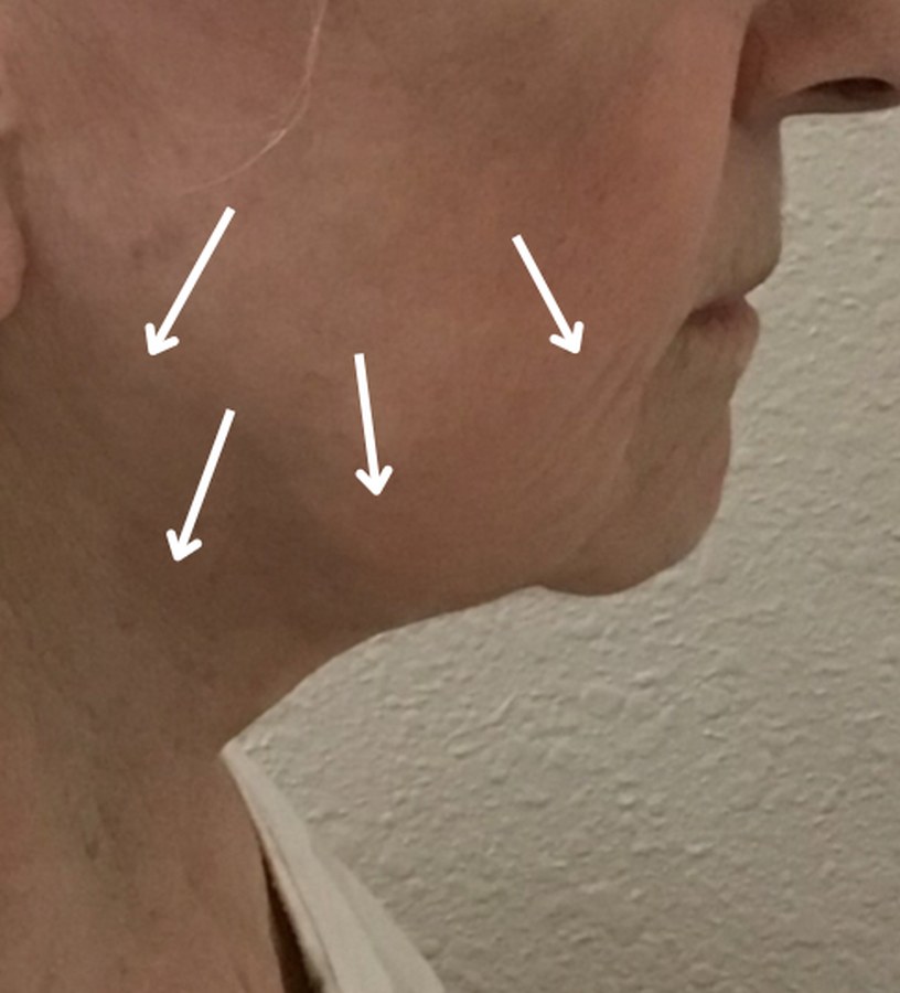 CryoSkin client after, face + jawline
