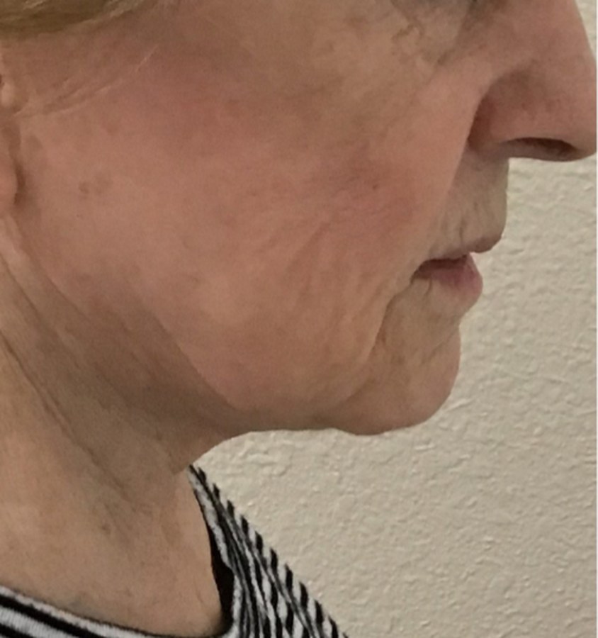 CryoSkin client before, face + jawline