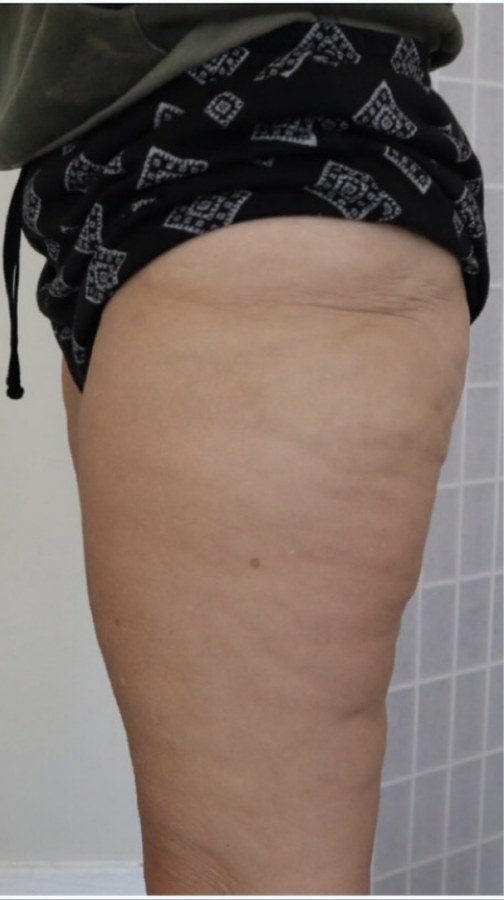 CryoSkin client after, thighs
