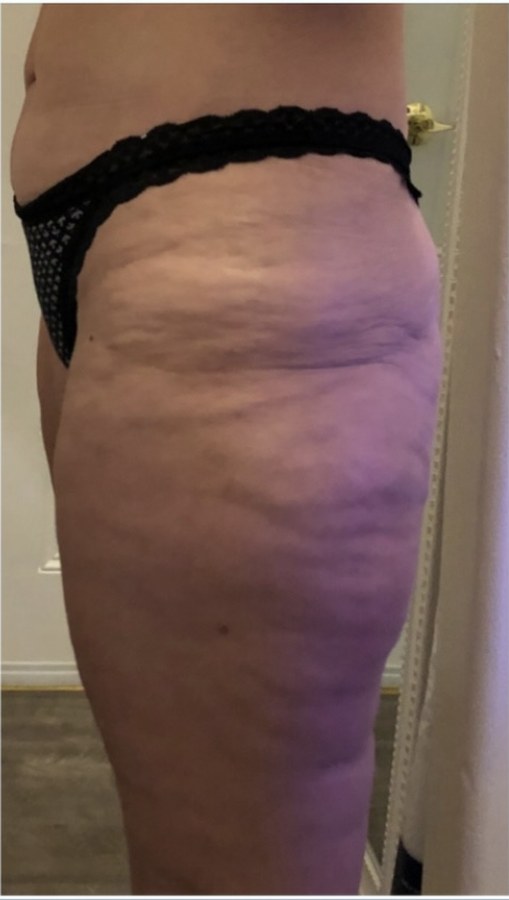 CryoSkin client before, thighs