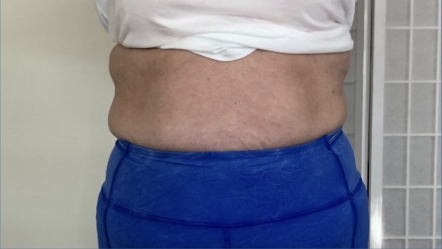 CryoSkin client after, stomach