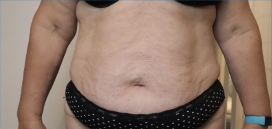 CryoSkin client before, stomach
