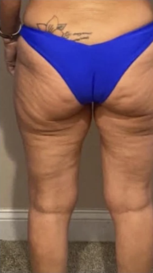CryoSkin client before, thighs + glutes