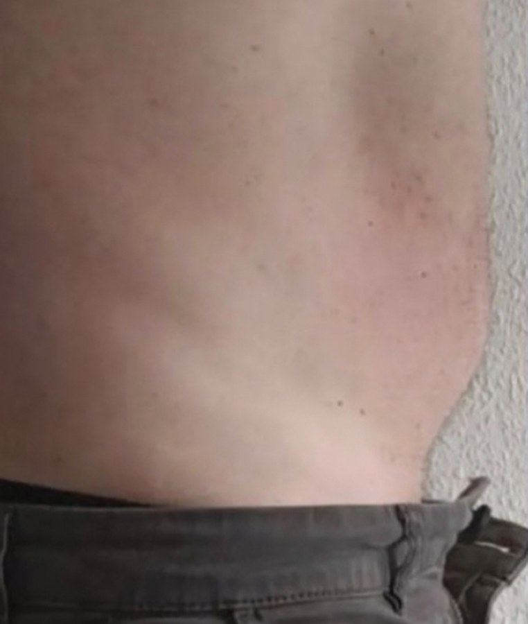 CryoSkin client after, stomach
