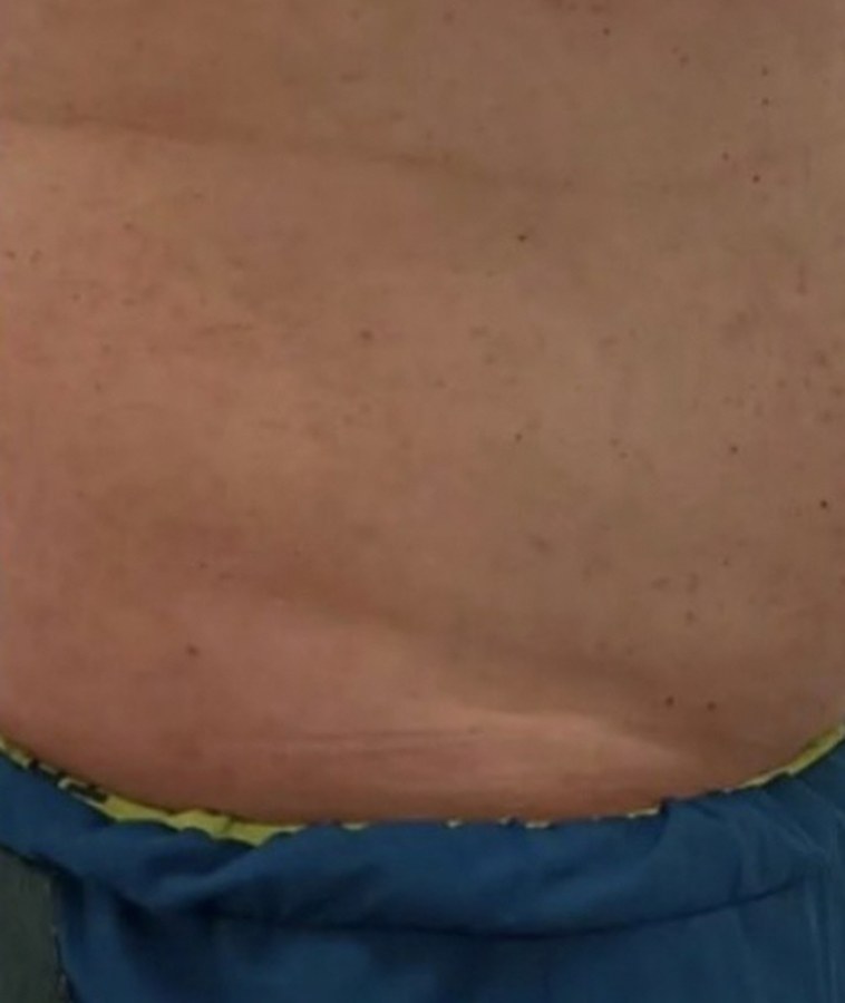 CryoSkin client before, stomach