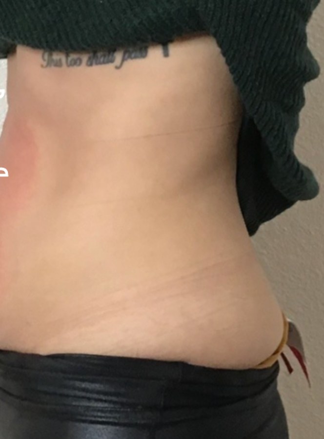CryoSkin client after, stomach