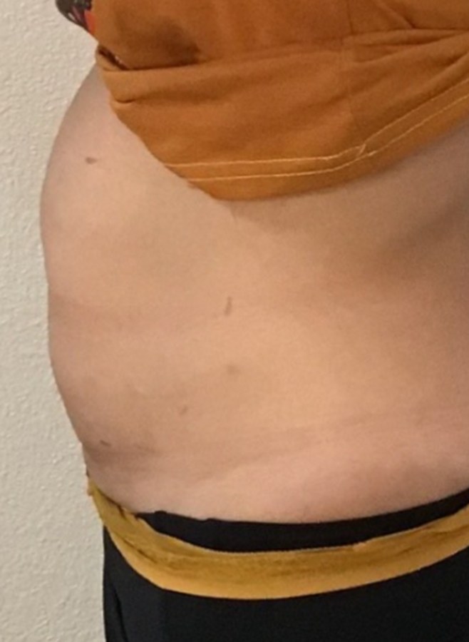 CryoSkin client before, stomach