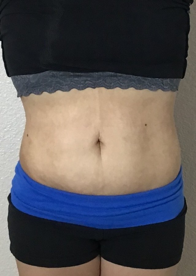 CryoSkin client after, stomach