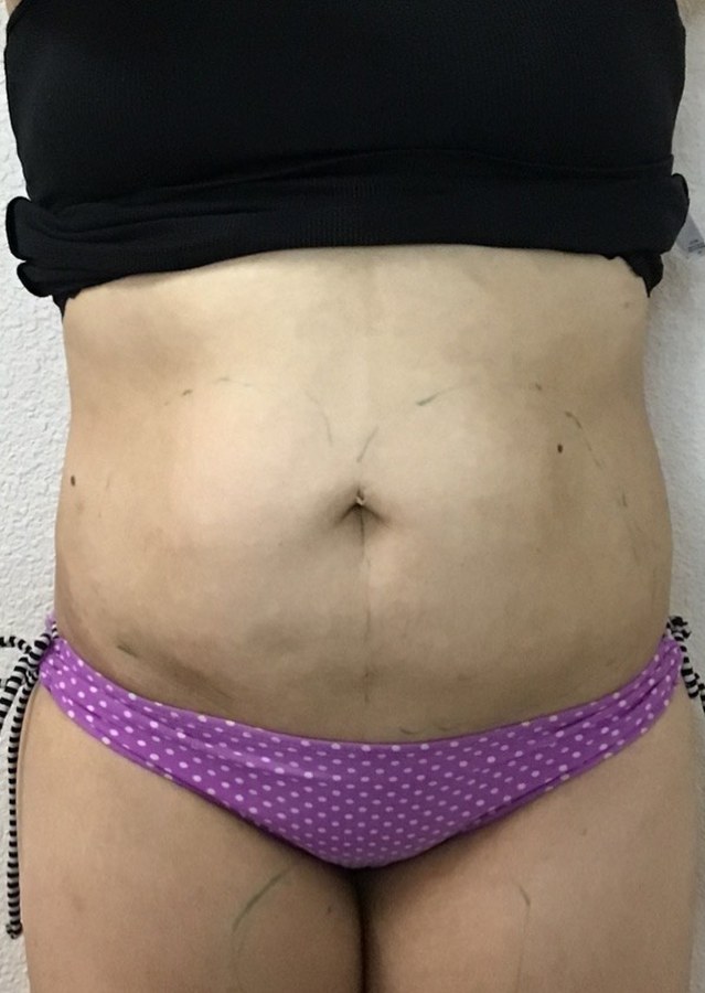 CryoSkin client before, stomach