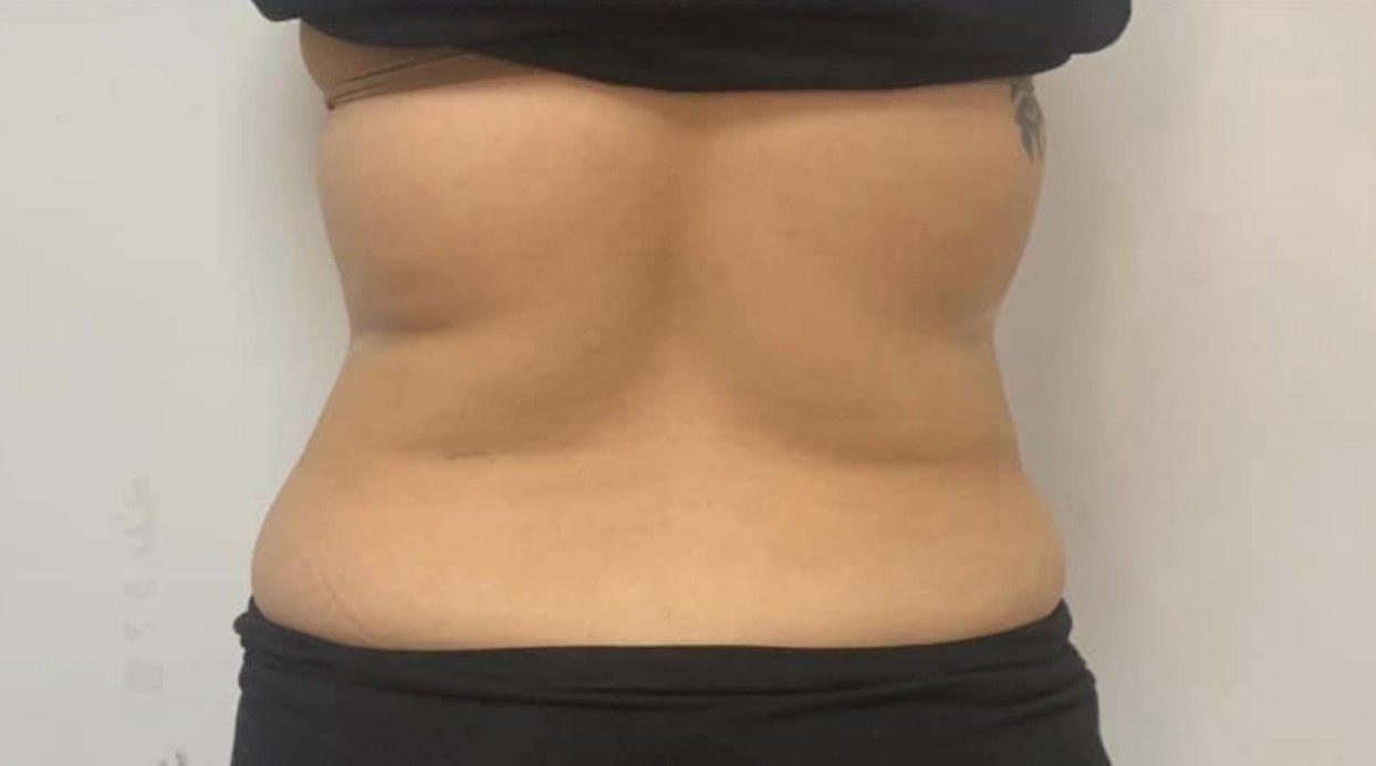 CryoSkin client after, back