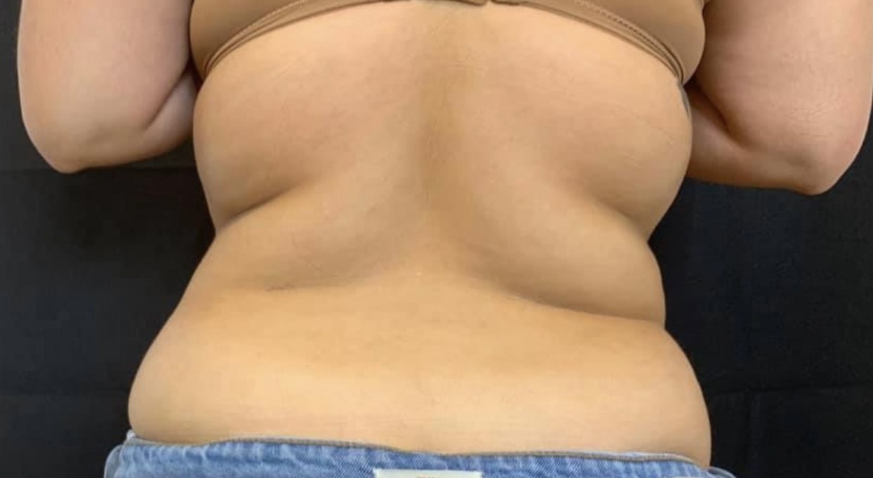 CryoSkin client before, back