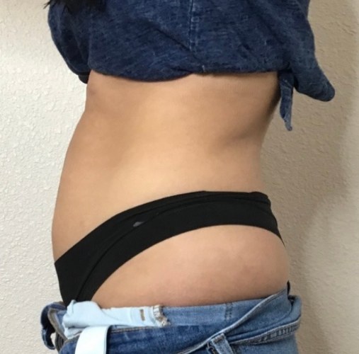 CryoSkin client after, stomach