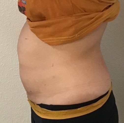 CryoSkin client before, stomach