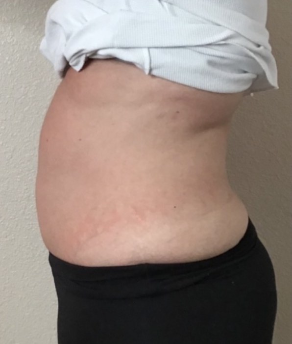 CryoSkin client after, stomach