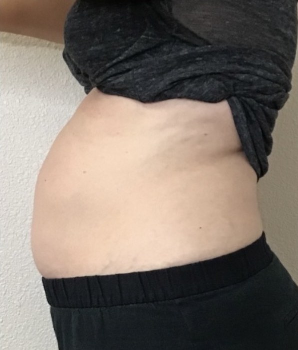 CryoSkin client before, stomach