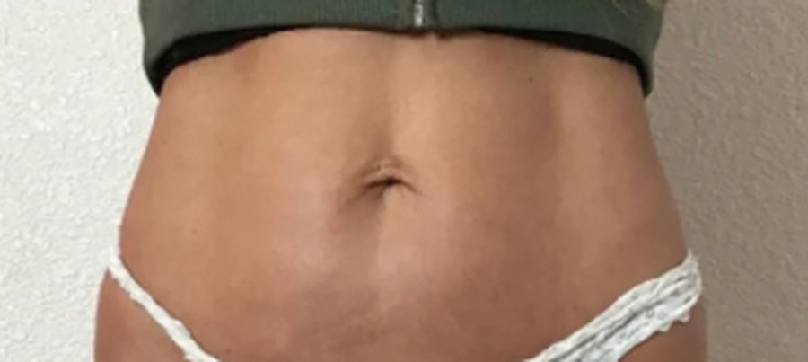 CryoSkin client after, stomach