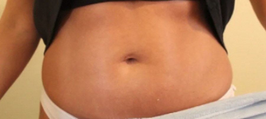 CryoSkin client before, stomach