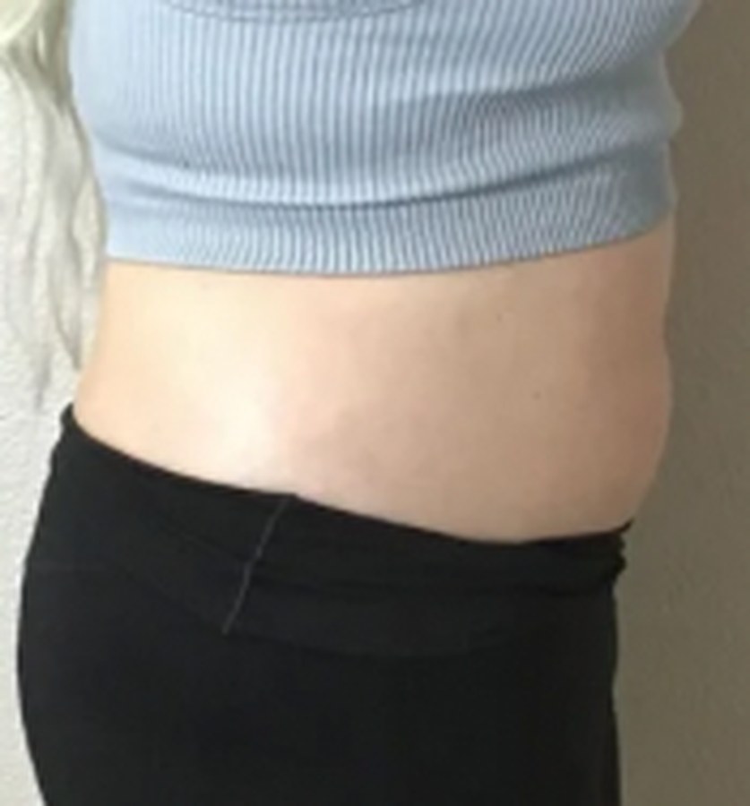 CryoSkin client after, stomach