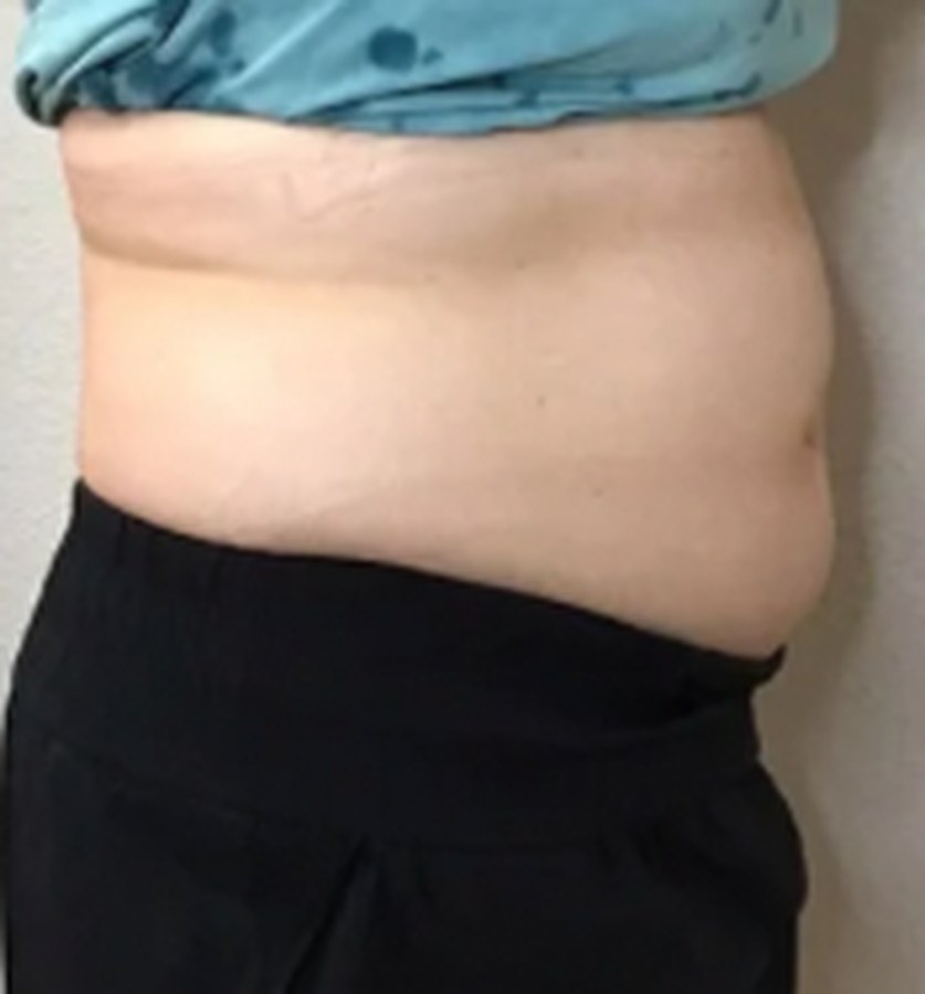 CryoSkin client before, stomach