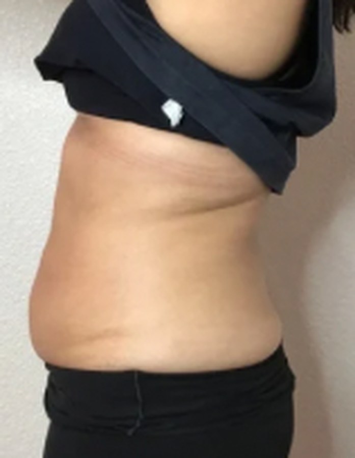 CryoSkin client before, waist