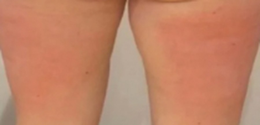 CryoSkin client after, thighs + cellulite