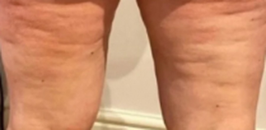 CryoSkin client before, thighs + cellulite