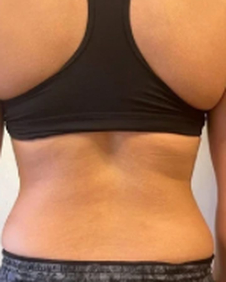 CryoSkin client after, back