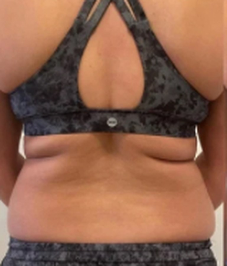 CryoSkin client before, back