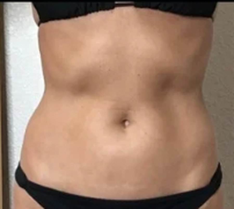 CryoSkin client after, stomach