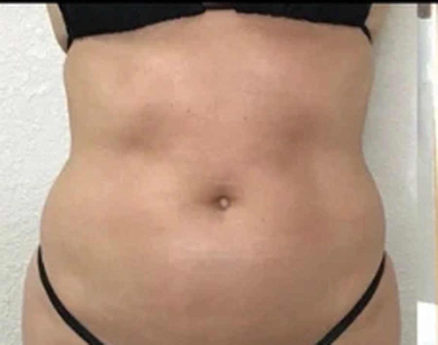 CryoSkin client before, stomach