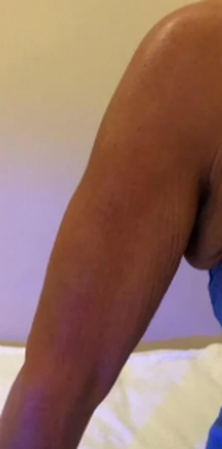 CryoSkin client after, arms