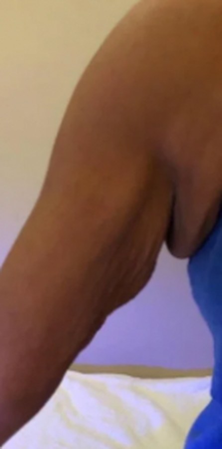 CryoSkin client before, arms
