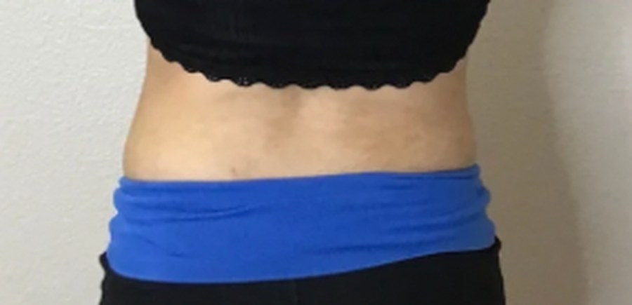 CryoSkin client after, back