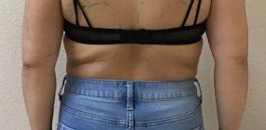 CryoSkin client before, back