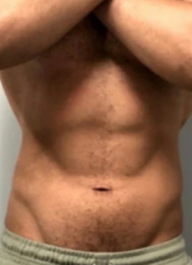CryoSkin client after, stomach