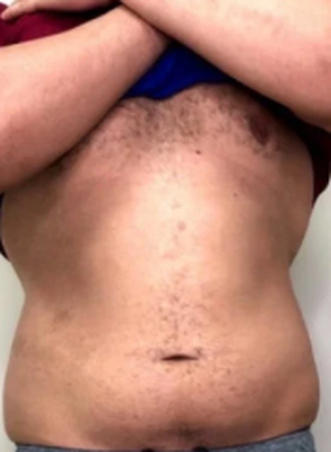 CryoSkin client before, stomach